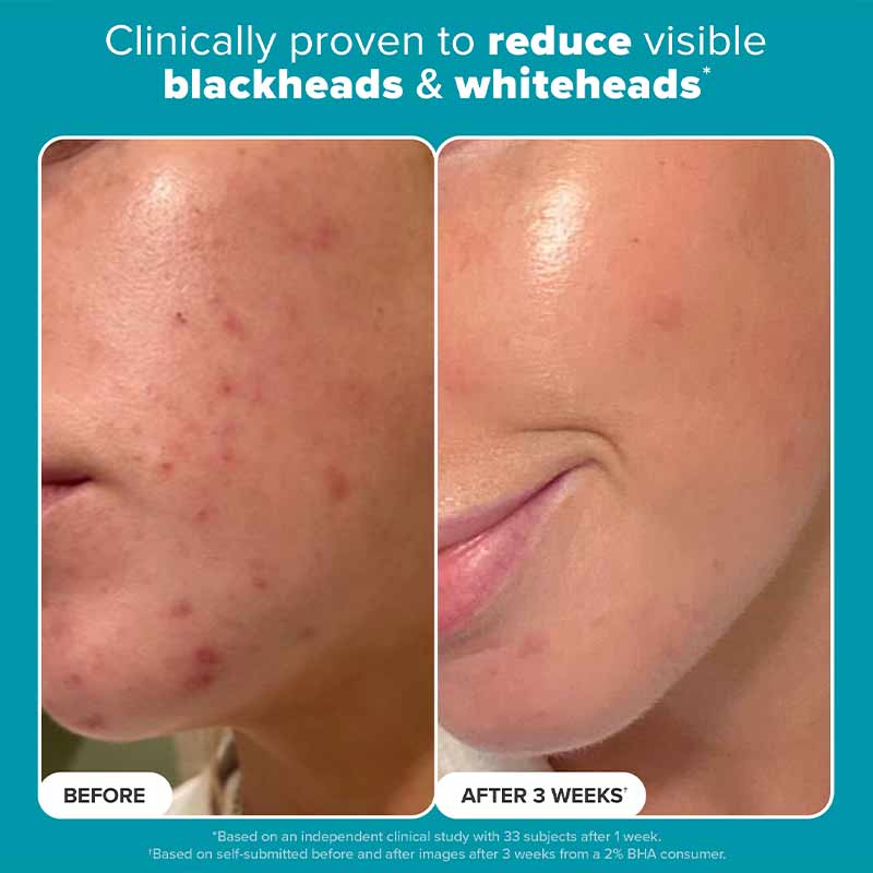Paula's Choice Skin Perfecting 2% BHA Liquid Exfoliant