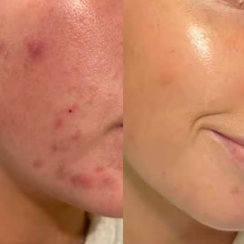 Paula's Choice Skin Perfecting 2% BHA Liquid Exfoliant Travel Size